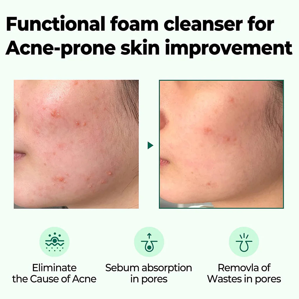 SOMEBYMI AHA-BHA-PHA 30 days Miracle Acne Clear Foam 100ml / 3.38 oz.