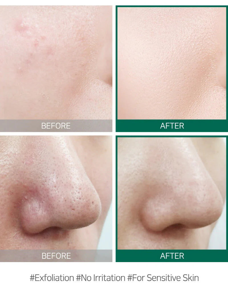 SOMEBYMI AHA-BHA-PHA 30 days Miracle Acne Clear Foam 100ml / 3.38 oz.